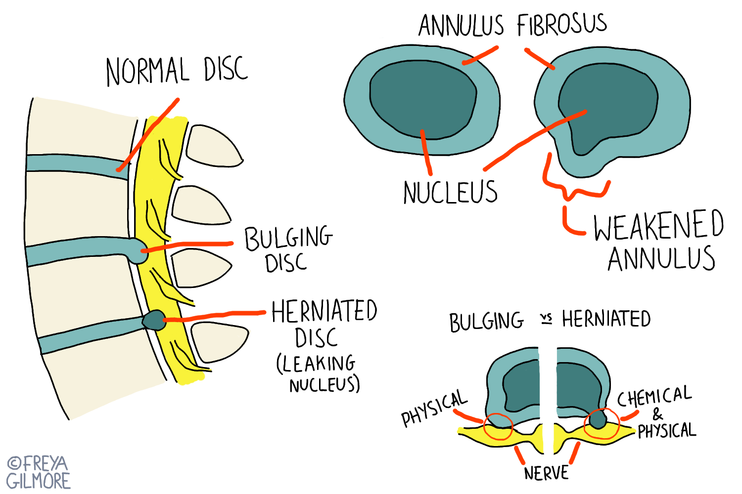 Osteo for Back Pain  Disc Prolapse vs Disc Bulges — Osteopath Hawthorn